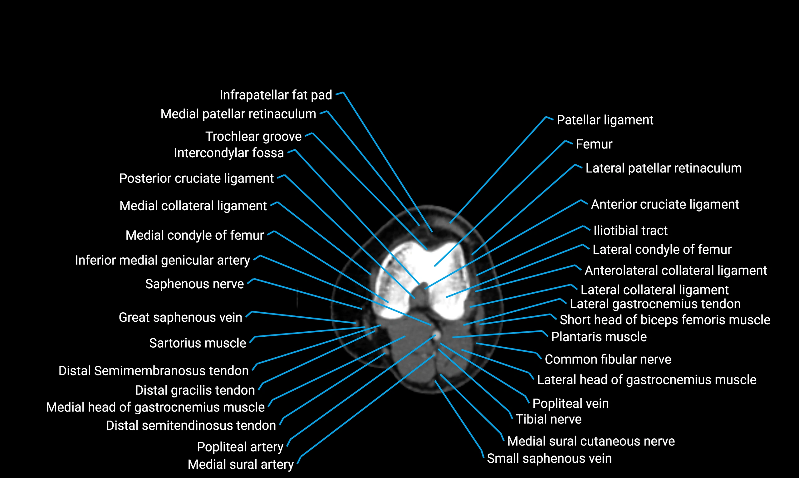CT lower limb axial cross sectional anatomy labelled image 88 (2).webp